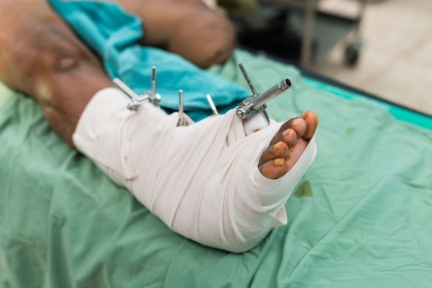 Patient's foot with surgical pins and white bandaging following ankle fracture surgery